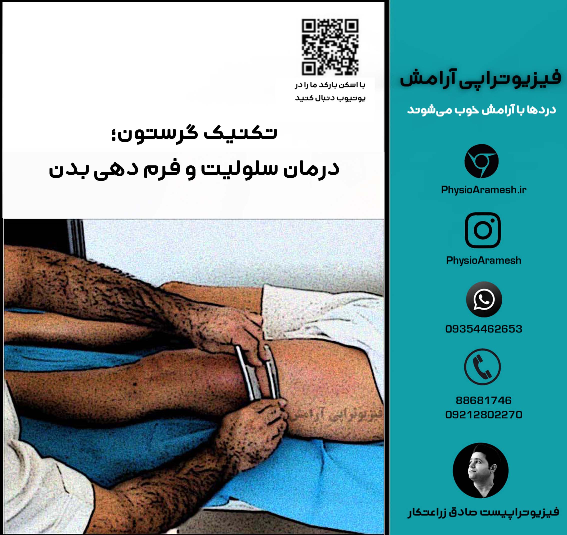 تکنیک گرستون؛ درمان سلولیت و فرم دهی بدن